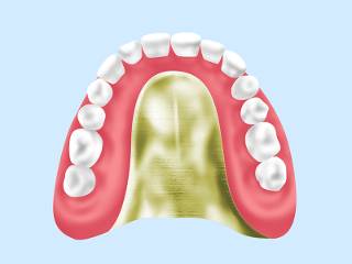 金属床義歯