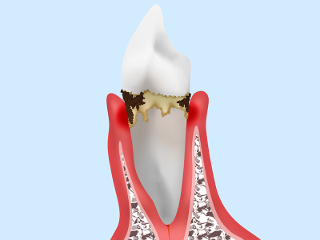歯肉炎